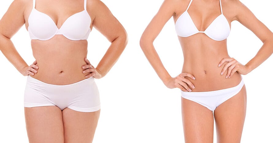 Liposuction Solution in Ghaziabad, Delhi NCR