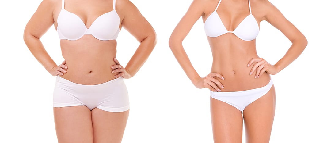 Liposuction Solution in Ghaziabad, Delhi NCR